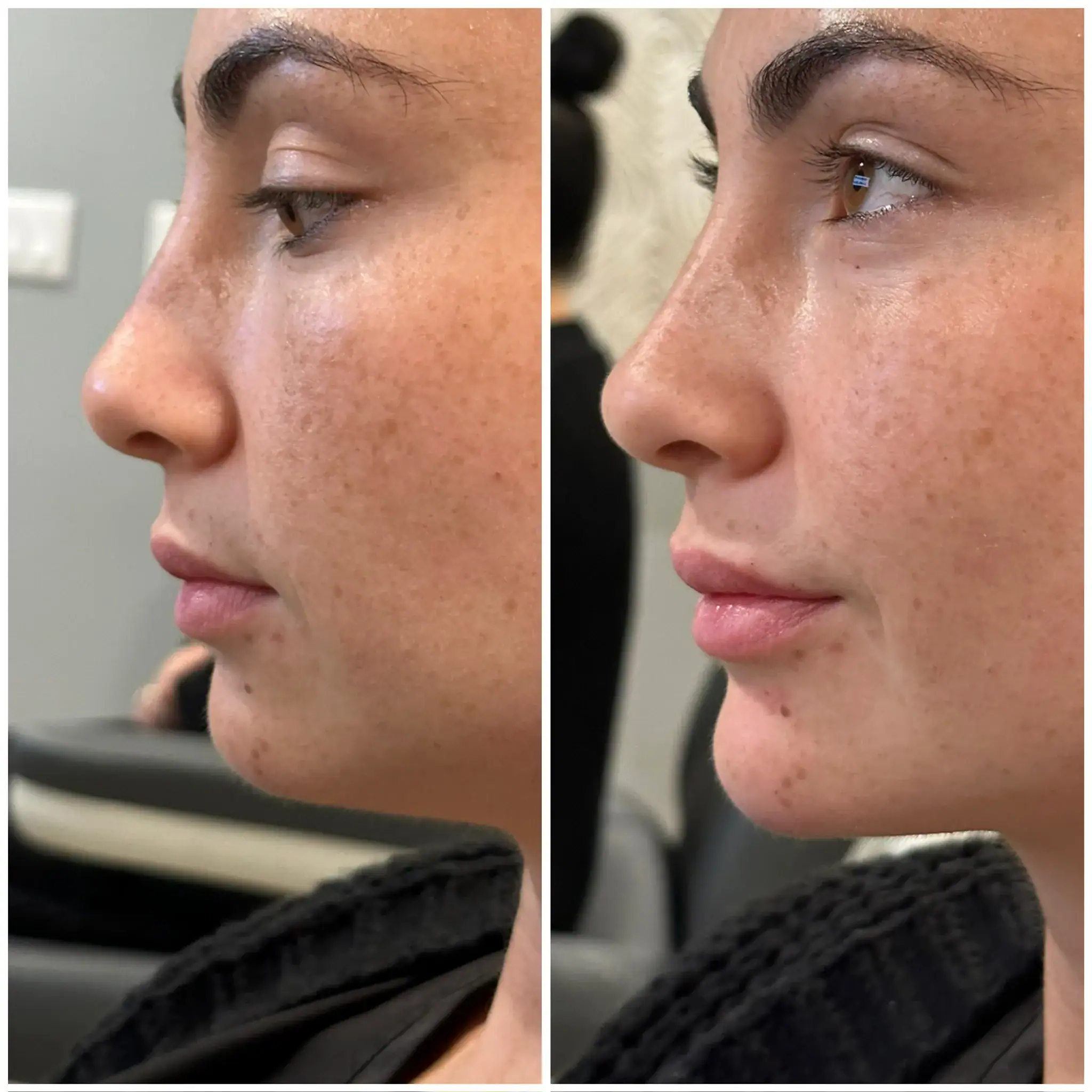 Side profile comparison before and after non-surgical rhinoplasty.